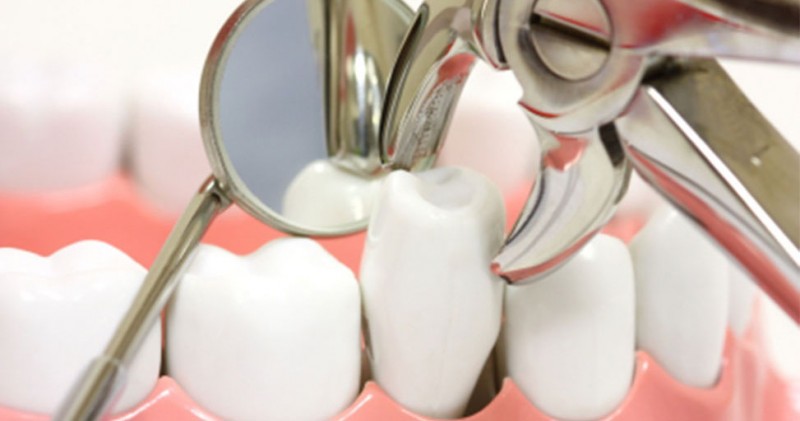 Szükséges-e a foghúzás a fogszabályozás során?