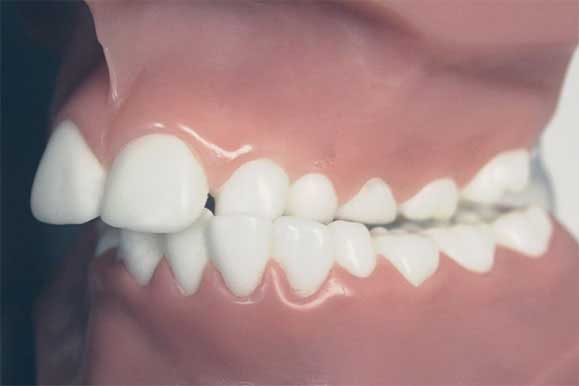 The HappySmile Invisible aligner can be applied similarly in case of any problems 